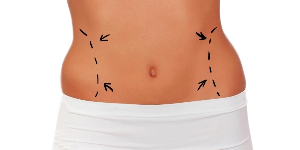 Liposuction(fat-removal)